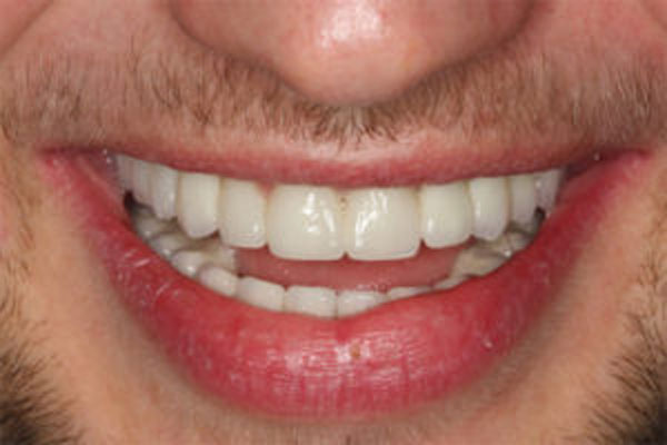 Stworzenie uśmiechu pacjenta z wrodzonym brakiem zębów